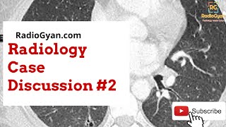 Pulmonary Langerhans Cell Histiocytosis amp common cystic lung diseases  Radiology Board Review Case [upl. by Ronnie]