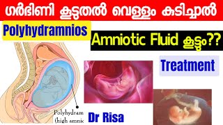 Pregnancy Complication Malayalam Polyhydramnios Amniotic fluid Normal level [upl. by Georgine]