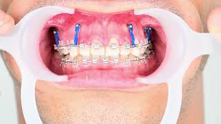 Surgery free gummysmile correction by connecting braces to tads [upl. by Naillimixam]