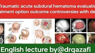 Traumatic acute subdural hematomaEnglish lecture evaluation treatment option outcome controversies [upl. by Ruon761]