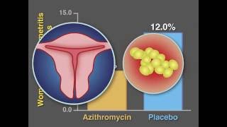 PostCesarean Infection and Antibiotic Prophylaxis  NEJM [upl. by Eniretac]