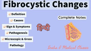 Fibrocystic Changes  Breast  Pathology  Hindi [upl. by Spatola]