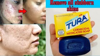 TURA Germicidal Medicated Soap Review  Get Rid Of Stubborn ACNE amp BLACKSPOTS [upl. by Alahc382]