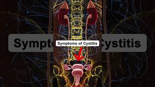 Symptoms of Cystitis cystitis health healthtips shorts [upl. by Nirac]