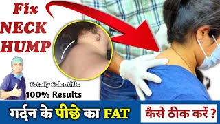 Neck Hump Exercises in Hindi  How to remove fatty Neck Hump  Dowagers hump Buffalo hump Exercise [upl. by Leodora]