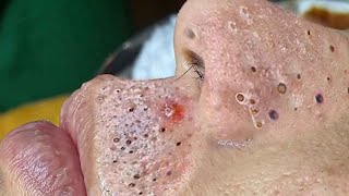 Big Cystic Acne Blackheads Extraction Blackheads amp Milia Whiteheads Removal Pimple Popping  313 [upl. by Glendon752]