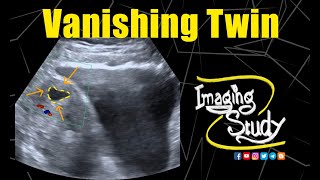 Vanishing Twin  Ultrasound  Case 142 [upl. by Ahseela601]