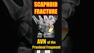 Fracture of the Scaphoid with Avascular Necrosis radiology doctor trauma [upl. by Enitsuj625]