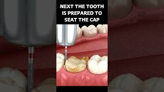 DENTAL CAP PROCEDURE  Dental cap kaise lagayi jati hai dentalcrowns teeth toothless tooth [upl. by Silrac849]