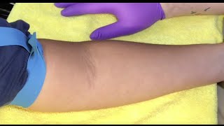 Tips For Locating Difficult Veins [upl. by Llemrej]