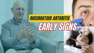 Rheumatoid Arthritis Symptoms You Should NOT Ignore [upl. by Carnay281]