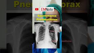 Spontaneous Pneumothorax doctor medical nursing [upl. by Aloin302]