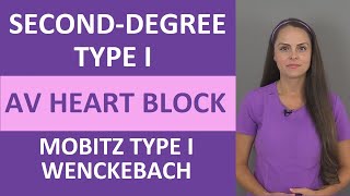 SecondDegree Type I AV Heart Block Nursing NCLEX ECG  Mobitz Type 1  Wenckebach [upl. by Kerns849]