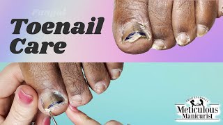 👣Lets Revisit  Toenail Fungus Care at Home👣 [upl. by Azzil318]