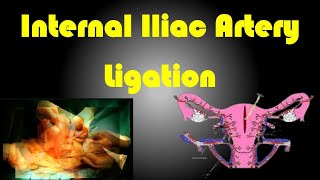 Internal Iliac Artery Ligation  Internal Iliac artery Ligation Procedure [upl. by Anayit]