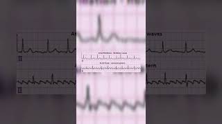 Atrial fibrillation vs Atrial flutter  Medicos  Cardiology [upl. by Becht944]