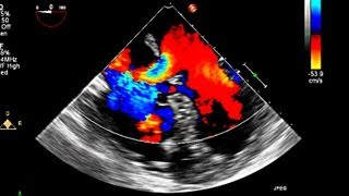 Atrial Septal Defect Primum Echocardiography [upl. by Hollister]