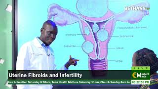 uterine fibroids and infertility [upl. by Senskell755]