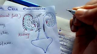 renal carcinoma pathology NGMedicals [upl. by Nedarb]