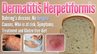 Dermatitis herpetiformis Causes Symptoms Treatment and glutenfree diet list  Duhring’s disease [upl. by Geordie]