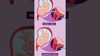 Short cervix during pregnancy 🫄Understanding Cervical Insufficiency pregnant September 8 2024 [upl. by Moser990]