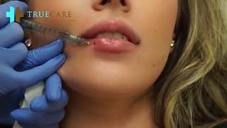 BABY BOTTOM LIP INJECTIONS [upl. by Enytnoel]