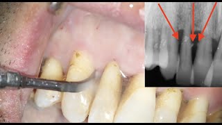 Igiene professionale scaling e root planing con strumenti sonici [upl. by Calia]