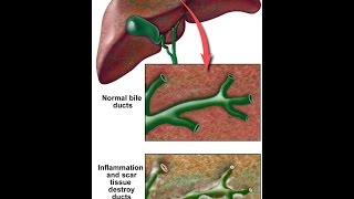 Primary Sclerosing Cholangitis [upl. by Rudy]