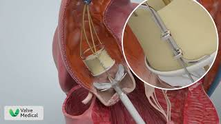 Valve Medicals Aortic Valve Replacement Animation [upl. by Gagnon500]