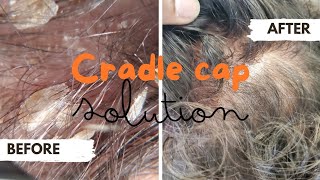 Fast Acting All Natural Cradle Cap Removal [upl. by Salman]