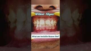 Invisible Braces be like this Clear Aligners for Teeth spacing Dr Srishti Bhatia smile braces [upl. by Vanzant]