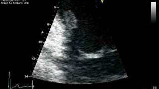 RUPTURE CHORDAE POSTEROMEDIAL PAPILARY MUSCLE  MR PROLAPSE [upl. by Dnomzed]