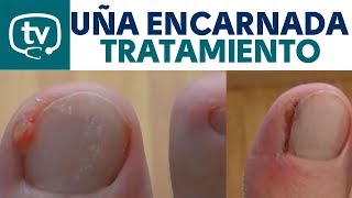 El tratamiento de la uña encarnada ¡Incluye imágenes [upl. by Arno907]