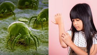 How To Get Rid of Scabies  Causes amp Remedies [upl. by Hennebery880]