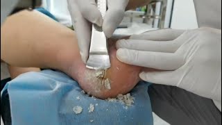 Remove Heel Fissure slowly amp carefully Cracked heel treatment amp Callus removal Dead skin removal [upl. by Hardner891]