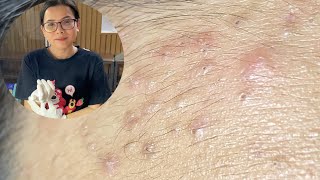 Acne Treatment Huong Da Nang  2024 blackheads 700 [upl. by Leonardo]