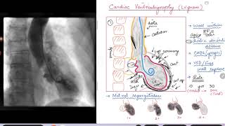 Cardiac Ventriculography Left Ventriculogram [upl. by Deach]