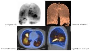 Respiratory gated 4D Lung Perfusion PETCT Imaging [upl. by Ok]