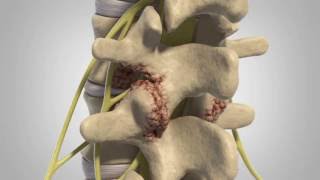 Lumbar Degenerative Disc Disease  Patient Animation [upl. by Enibas]