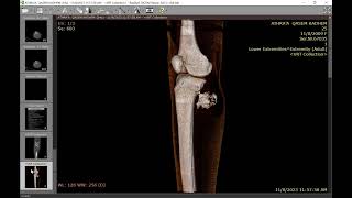 Complicated osteochondroma [upl. by Marilee805]