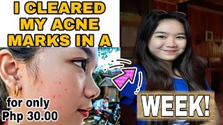 CHEAPEST PRODUCT TO CURE PIMPLES IN JUST A WEEK  Philippines [upl. by Ardella]