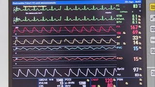 Enfermedades del Auge Infarto al miocardio [upl. by Trevethick]