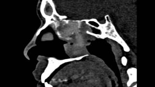 Allergic Fungal Sinusitis [upl. by Ledeen]