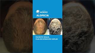 Alopecia [upl. by Helman782]