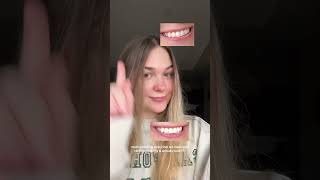 Lumineux teeth whitening strips before vs after linked in description teethwhitening [upl. by Gerty]