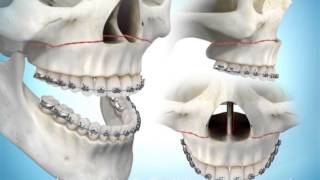 Maxillary Advancement Surgery [upl. by Ellocin]