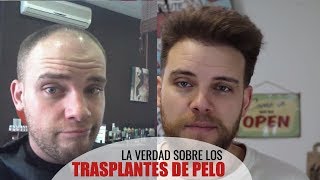 LA VERDAD SOBRE LOS TRASPLANTES DE PELO [upl. by Natelson]