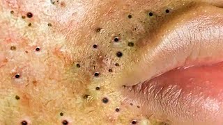 Big Cystic Acne Blackheads Extraction Blackheads amp Milia Whiteheads Removal Pimple Popping  3729 [upl. by Gleeson366]