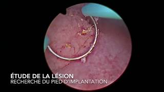 chirurgie endoscopique  résection de polype de vessie par voie transurétral [upl. by Pendleton]