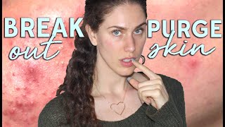 Skin Purge VS Breakouts  How To Tell If Youre Having A Product Reaction [upl. by Iarised]